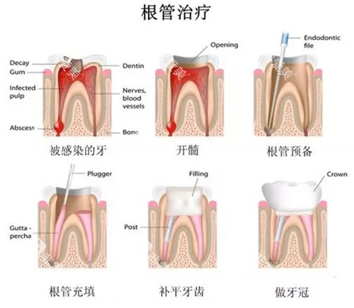 牙齿根管治疗过程图 牙齿根管治疗过程图