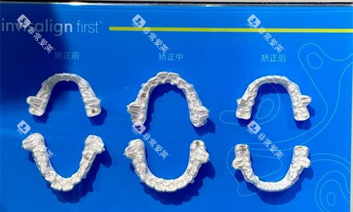 东莞好佰年口腔室外展示矫正成效对比图 东莞好佰年口腔室外展示矫正成效对比图