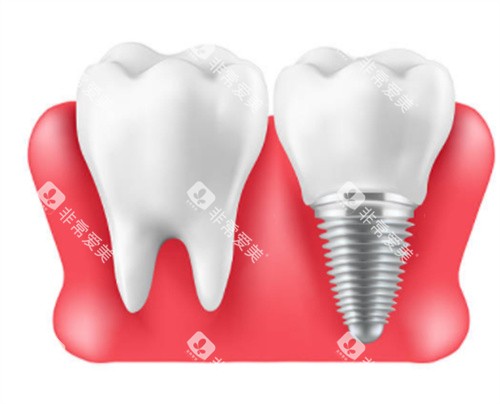 自然牙和种植牙