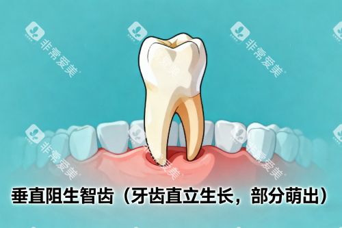 垂直阻生智齿展示图