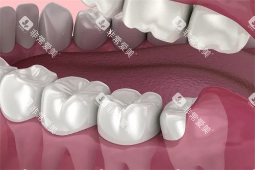 牙龈包裹住智齿