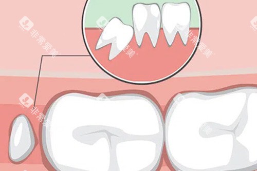 长智齿的初期示意图