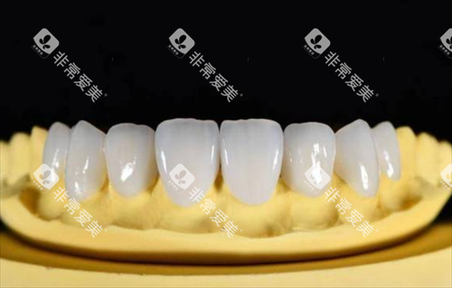 全瓷牙模拟展示