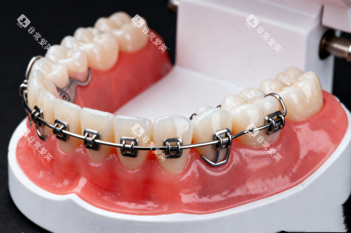 传统牙齿矫正器模型展示图 传统牙齿矫正器模型展示图