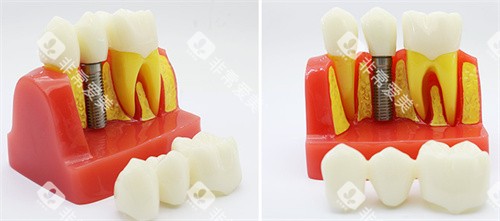 种植牙模具 图片 种植牙模具 图片