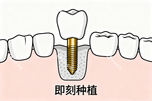 牙齿即刻种植卡通图 牙齿即刻种植卡通图