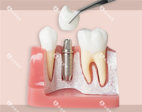 种植牙模具图片 种植牙模具图片