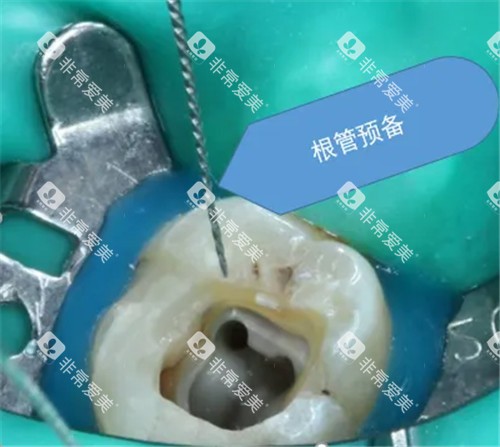 根管治疗治疗图 根管治疗治疗图