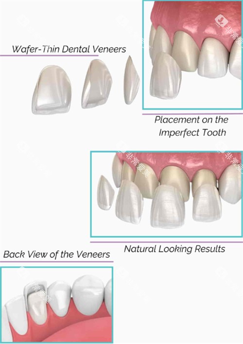 牙齿贴面的过程 牙齿贴面的过程
