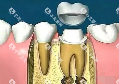 根管治疗后带牙冠 根管治疗后带牙冠
