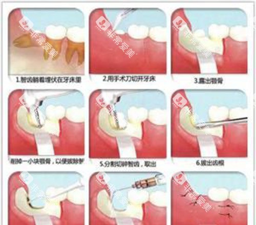拔智齿过程示意图 拔智齿过程示意图