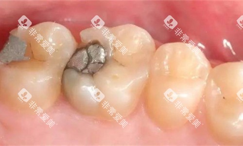 牙齿金属补牙图 牙齿金属补牙图