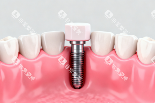 种植牙植入口腔模型图