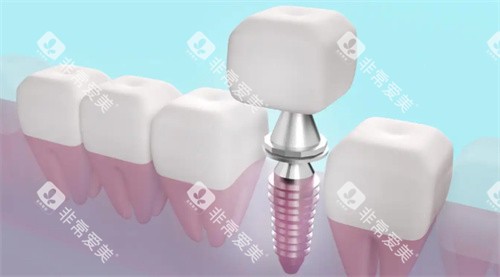 种植牙透视动画展示图