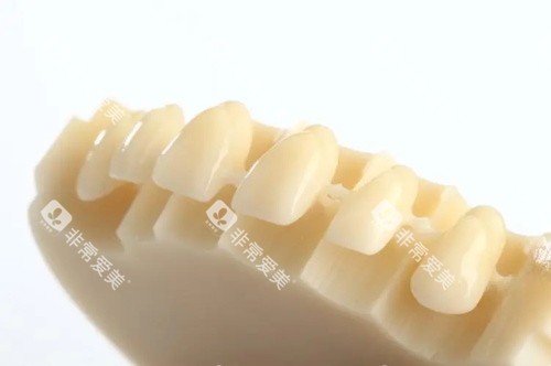 国产美晶瓷全瓷牙展示图