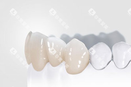 全瓷牙冠模型图