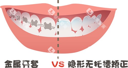 牙齿矫正牙套金属对比隐形牙套
