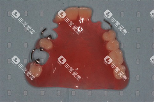 半口可摘局部义齿展示图