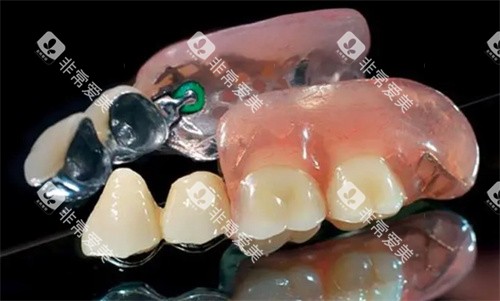 精密附着体义齿