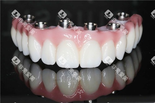 氧化锆义齿