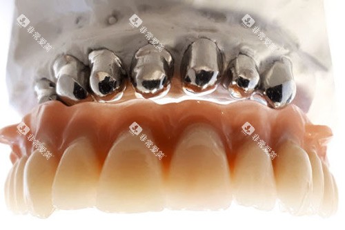 套筒冠义齿示意图