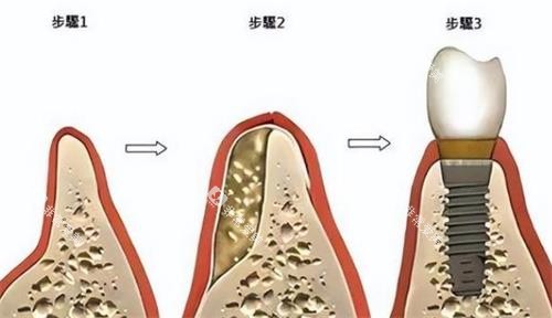 牙科骨粉的使用方法 牙科骨粉的使用方法