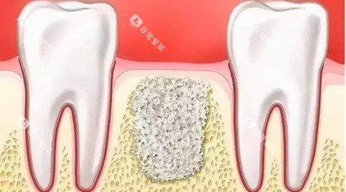 骨粉示意图 骨粉示意图