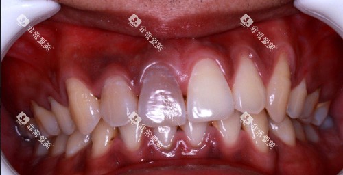 牙齿龋坏表现图 牙齿龋坏表现图