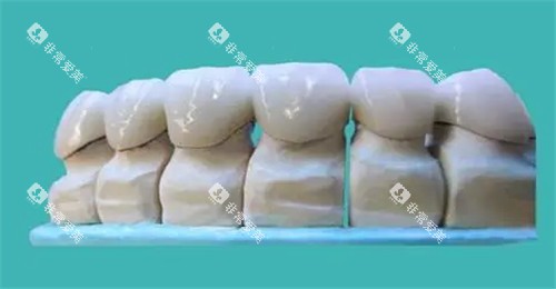 牙齿修复模型图 牙齿修复模型图