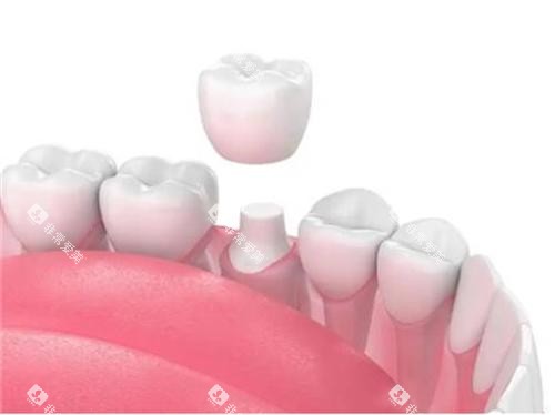 牙齿戴牙冠示意图