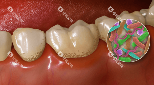 牙齿污垢卡通示意图 牙齿污垢卡通示意图