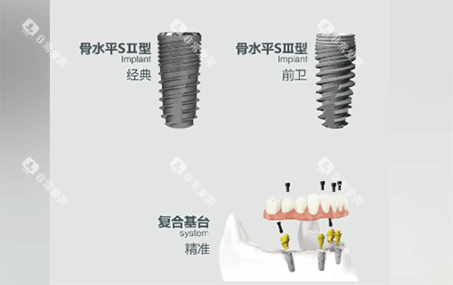 安联种植牙用起来怎么样 安联种植牙用起来怎么样