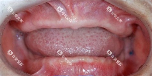 全口牙齿脱落示意图