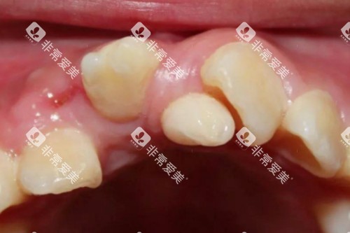 牙齿畸形问题模型图