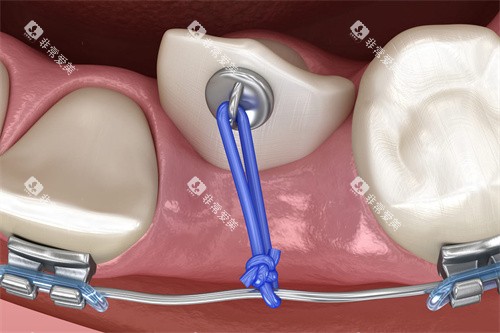 下颌牙齿牵引 下颌牙齿牵引