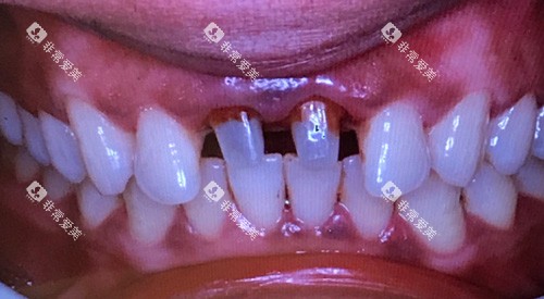 牙齿治疗细节图 牙齿治疗细节图