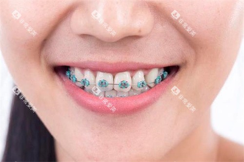 牙齿正畸宣传 牙齿正畸宣传