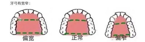 牙齿矫正牙弓形状