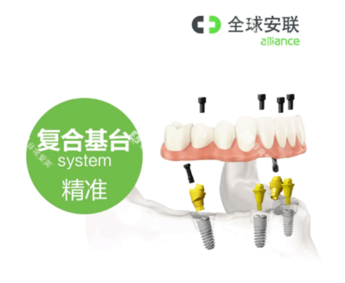 安联种植牙复合基台照片