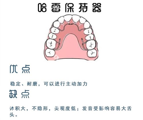 牙齿矫正哈雷保持器