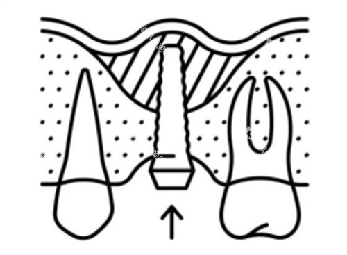 上颌窦种植牙简笔图