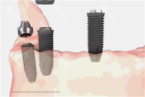 种植牙操作细节 种植牙操作细节