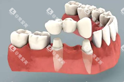 烤瓷牙冠展示图