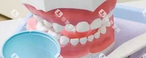 全口活动假牙展示