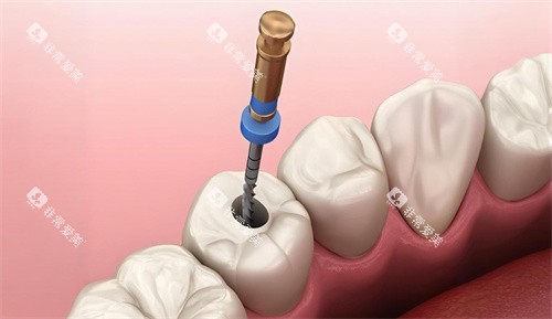 根管治疗过程展示