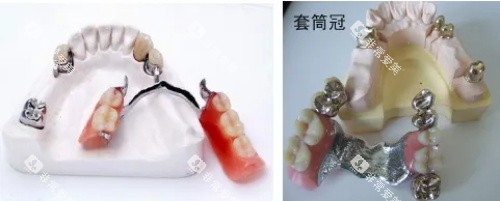 无挂钩假牙展示图