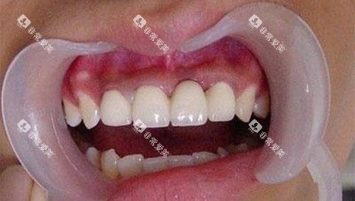 烤瓷牙后的牙齿情况 烤瓷牙后的牙齿情况
