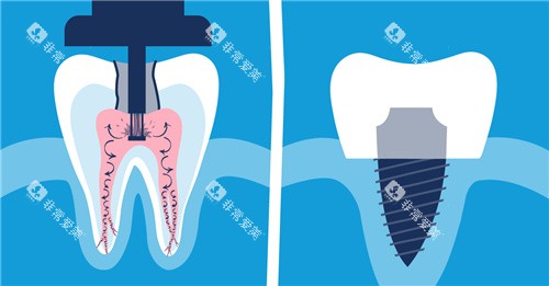 根管填充 根管填充