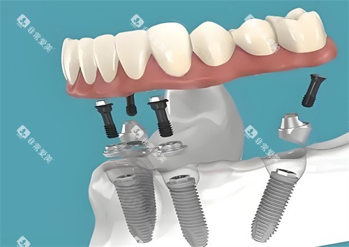 种植牙图片展示图 种植牙图片展示图
