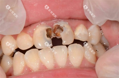 牙齿龋坏 牙齿龋坏